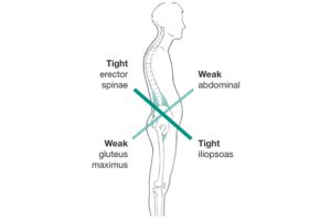 Lower Cross Syndrome – Trinity Help and Rehab